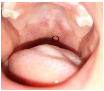 判斷孩子的病是不是皰疹性咽峽炎方法 皰疹性咽峽炎和與手足口病有什么區別
