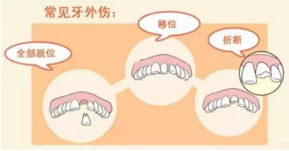 孩子的牙磕破了怎么處理比較好 孩子牙齒破了要去醫院嗎