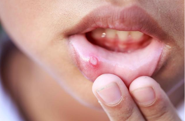 口腔潰瘍是上火了嗎 口腔潰瘍怎么治才好