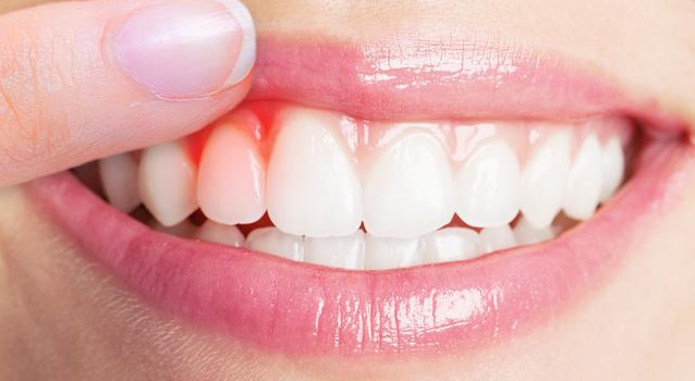 口腔潰瘍是上火了嗎 口腔潰瘍怎么治才好