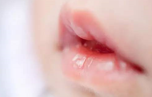 寶寶口腔上有白泡是鵝口瘡嗎 寶寶長了鵝口瘡怎么辦