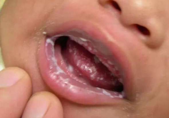 寶寶口腔上有白泡是鵝口瘡嗎 寶寶長了鵝口瘡怎么辦