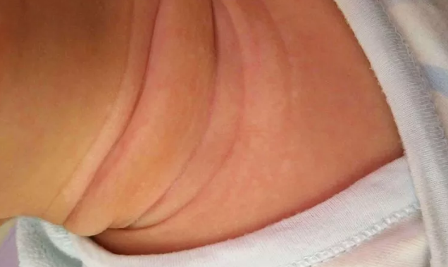 孩子有淹脖子可以用痱子粉嗎 孩子淹脖子了怎么治療