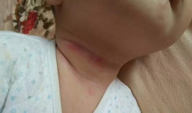 孩子有淹脖子可以用痱子粉嗎 孩子淹脖子了怎么治療