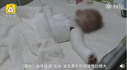 孩子突發(fā)被燙傷怎么辦 夏季孩子被燙傷正確處理方法