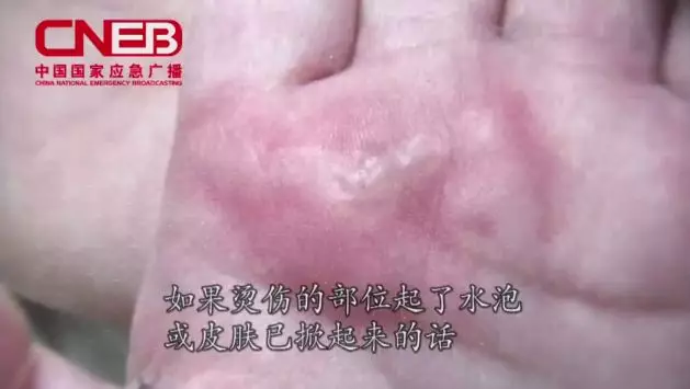 孩子被燙傷具體急救方法 孩子被燙傷部位怎么處理比較好