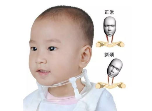 寶寶歪頭是斜頸嗎 寶寶斜頸怎么矯正