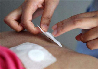 三伏貼應(yīng)該怎么貼 貼三伏貼要注意什么