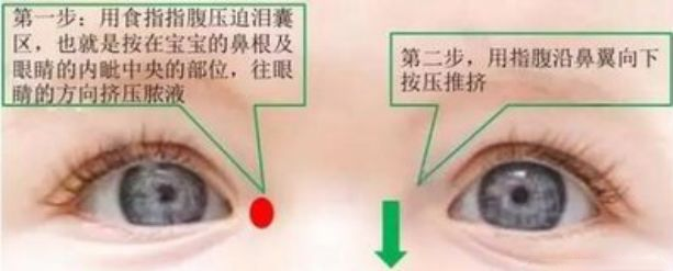 寶寶確定是淚囊炎怎么護理 怎么清理淚囊炎出現的眼屎