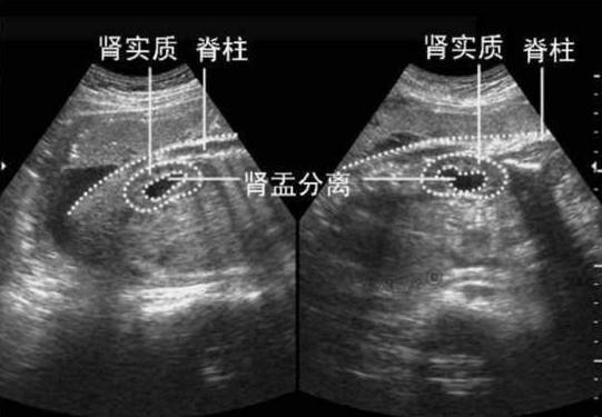 腎盂分離是生男孩嗎 哪些情況會導致胎兒出現腎盂分離