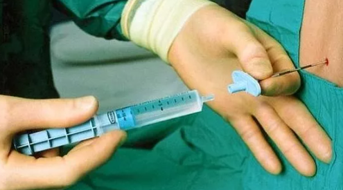 順產側切縫針打麻藥嗎 側切真的不打麻藥生切嗎