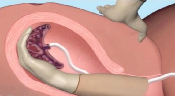 手剝胎盤是用手進(jìn)去撕?jiǎn)?手剝胎盤有危險(xiǎn)嗎