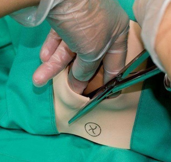 側切和撕裂哪個對身體傷害大 側切和撕裂會影響性生活嗎 側切和撕裂哪個對身體傷害大 側切和撕裂會影響性生活嗎