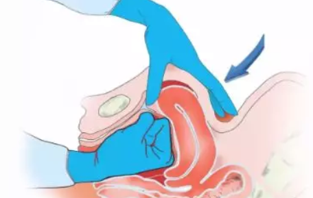 羊水栓塞是什么意思 分娩出現(xiàn)羊水栓塞有多危險(xiǎn)