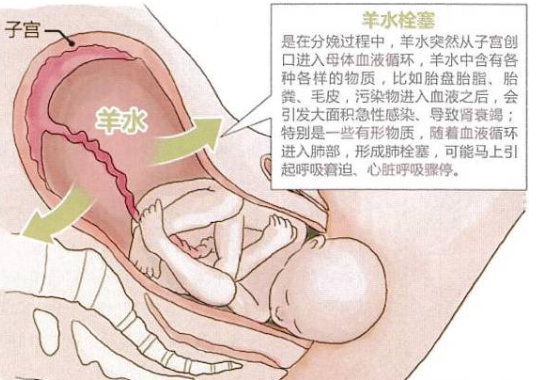 羊水栓塞可以完全預防嗎 羊水栓塞能提前檢查出來嗎