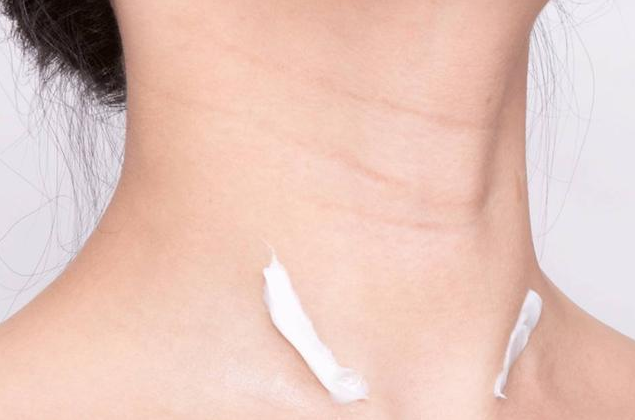 頸紋深怎么辦 怎么淡化頸紋