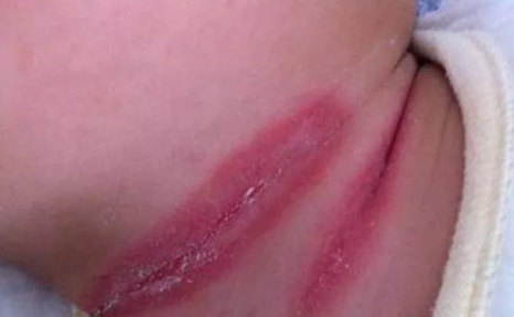 嬰兒間擦疹怎么護理 夏天寶寶間擦疹要注意什么