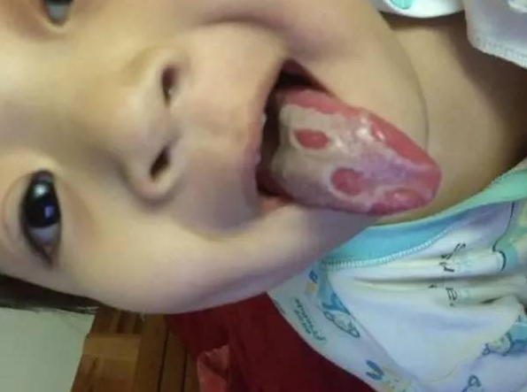 寶寶地圖舌要做哪些檢查 寶寶長地圖舌有什么危害