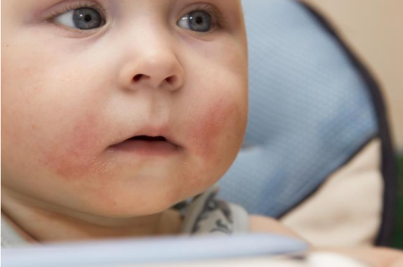 哪些食物容易引起寶寶過敏 7種易過敏食物介紹