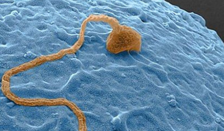 女性有滴蟲性陰道炎是出軌嗎 被滴蟲感染該做什么檢查