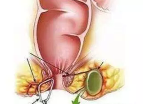 寶寶肛瘺癥狀有哪些 寶寶肛周囊腫的幾個發展期 寶寶肛瘺癥狀有哪些 寶寶肛周囊腫的幾個發展期