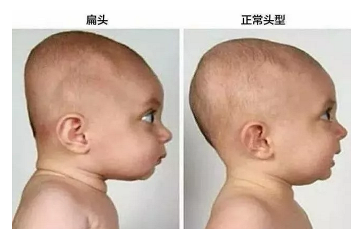 孩子的頭型多大會定型 什么時候可以給孩子睡頭型
