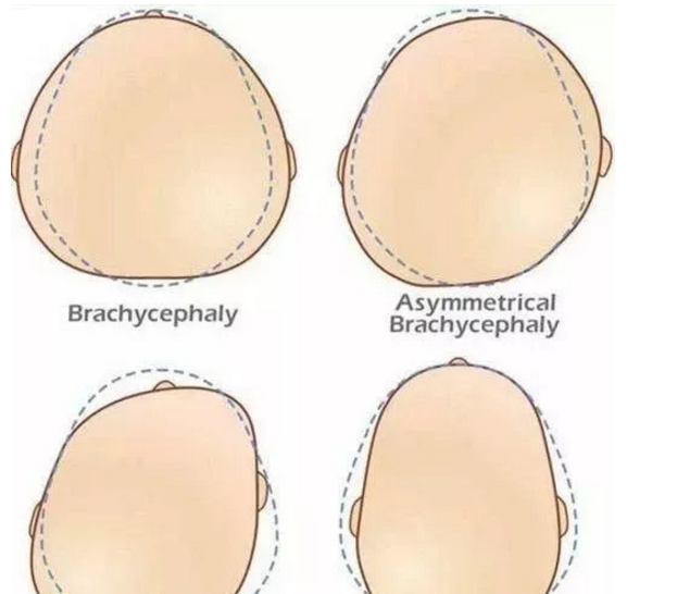 孩子的頭型多大會定型 什么時候可以給孩子睡頭型