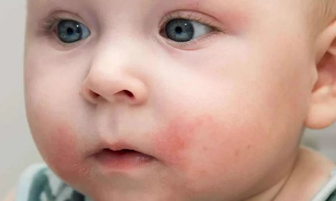 三伏天寶寶長痱子怎么應對 寶寶長痱子了怎么好的快