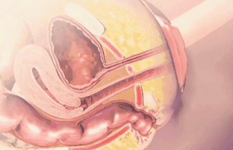 剖宮產(chǎn)要做盆底肌治療嗎 剖宮產(chǎn)不做順產(chǎn)才做盆底肌治療嗎