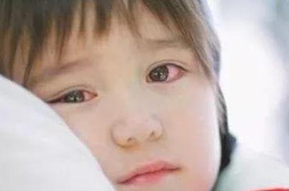 寶寶得了紅眼病還能眼罩嗎 小兒紅眼病推拿手法