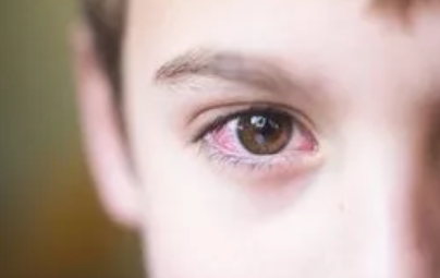 寶寶得了紅眼病還能眼罩嗎 小兒紅眼病推拿手法