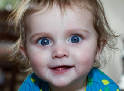 寶寶得了紅眼病還能眼罩嗎 小兒紅眼病推拿手法