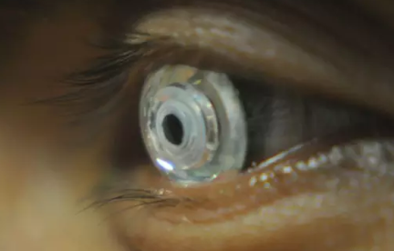 可變焦隱形眼鏡是什么 可變焦隱形眼鏡有什么用