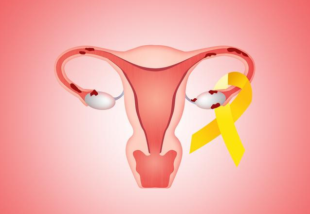 子宮內膜炎會引起不孕嗎,子宮內膜炎怎么護理好 子宮內膜炎會引起不孕嗎,子宮內膜炎怎么護理好