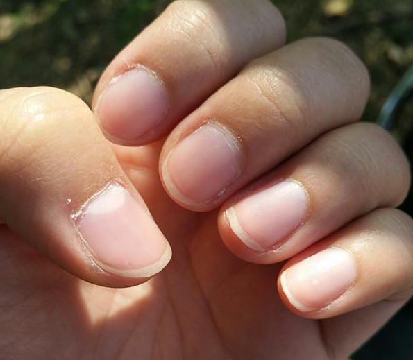 甲溝炎反復(fù)治不好是怎么回事 甲溝炎治療方法 甲溝炎反復(fù)治不好是怎么回事 甲溝炎治療方法