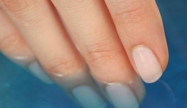 甲溝炎反復(fù)治不好是怎么回事 甲溝炎治療方法 甲溝炎反復(fù)治不好是怎么回事 甲溝炎治療方法