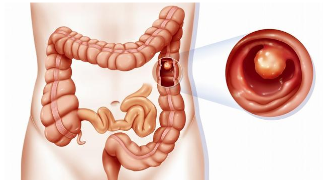 宮頸糜爛不治療會(huì)自己好嗎 宮頸糜爛護(hù)理注意事項(xiàng)