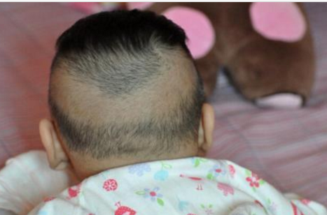 寶寶枕禿就是缺鈣嗎 寶寶枕禿是什么原因 寶寶枕禿就是缺鈣嗎 寶寶枕禿是什么原因