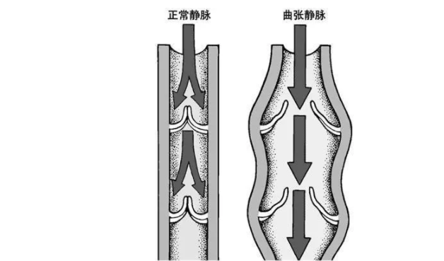 精索靜脈曲張手術是早好還是晚好 精索靜脈曲張手術會復發嗎 精索靜脈曲張手術是早好還是晚好 精索靜脈曲張手術會復發嗎