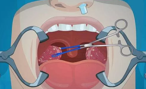 寶寶腺樣體肥大吃什么好 腺樣體肥大飲食注意事項 寶寶腺樣體肥大吃什么好 腺樣體肥大飲食注意事項