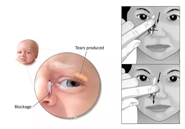 孩子的眼屎多正常嗎 孩子眼屎多是不是淚囊炎 孩子的眼屎多正常嗎 孩子眼屎多是不是淚囊炎