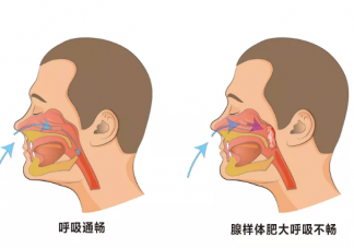 寶寶腺樣體肥大怎么辦 腺樣體肥大能治好嗎