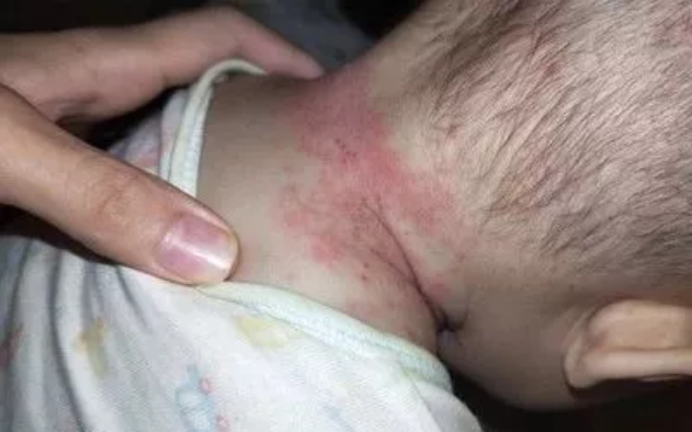 夏季寶寶多發(fā)疾病有哪些 幾種夏季寶寶常發(fā)的的疾病匯總