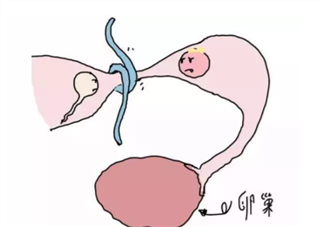 女性結扎還能懷孕嗎 女性結扎后能復通嗎