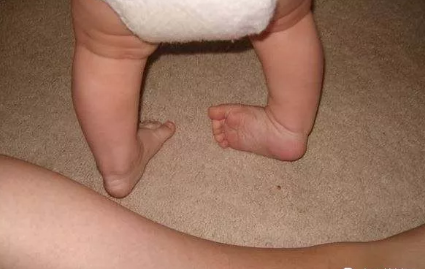 孩子走路內八字是什么原因 孩子走路內八需要治療嗎