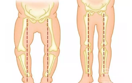 孩子走路內八字是什么原因 孩子走路內八需要治療嗎
