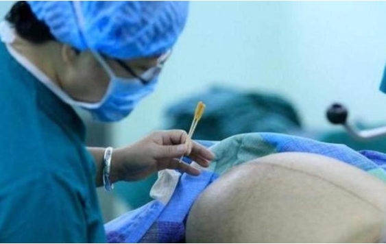 生產(chǎn)前為什么要刮毛 產(chǎn)婦可以自己在家備皮嗎