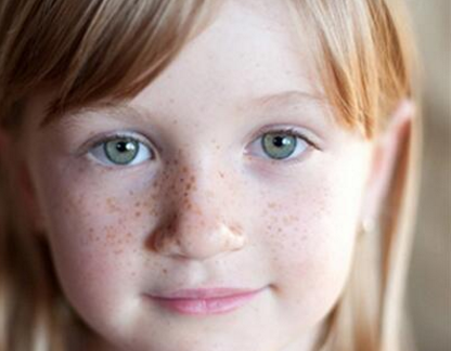 8歲的孩子長雀斑是什么原因 孩子長雀斑什么時候治療最好