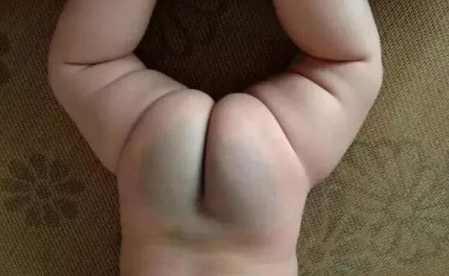 寶寶屁股上的淤青是什么 關(guān)于寶寶屁股上淤青的迷信說法 寶寶屁股上的淤青是什么 關(guān)于寶寶屁股上淤青的迷信說法