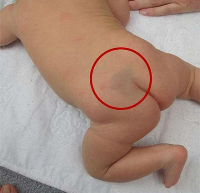 寶寶屁股上的淤青是什么 關(guān)于寶寶屁股上淤青的迷信說法 寶寶屁股上的淤青是什么 關(guān)于寶寶屁股上淤青的迷信說法